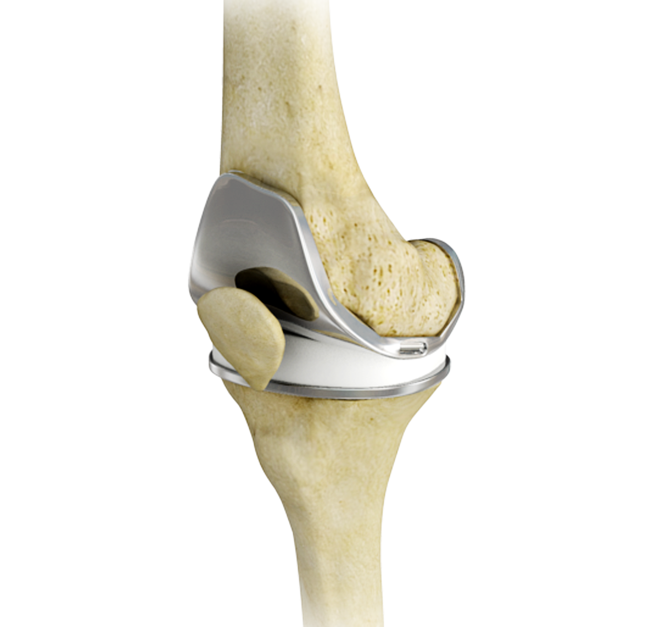 Total Knee Arthroplasty